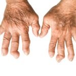 rheumatoid arthritis