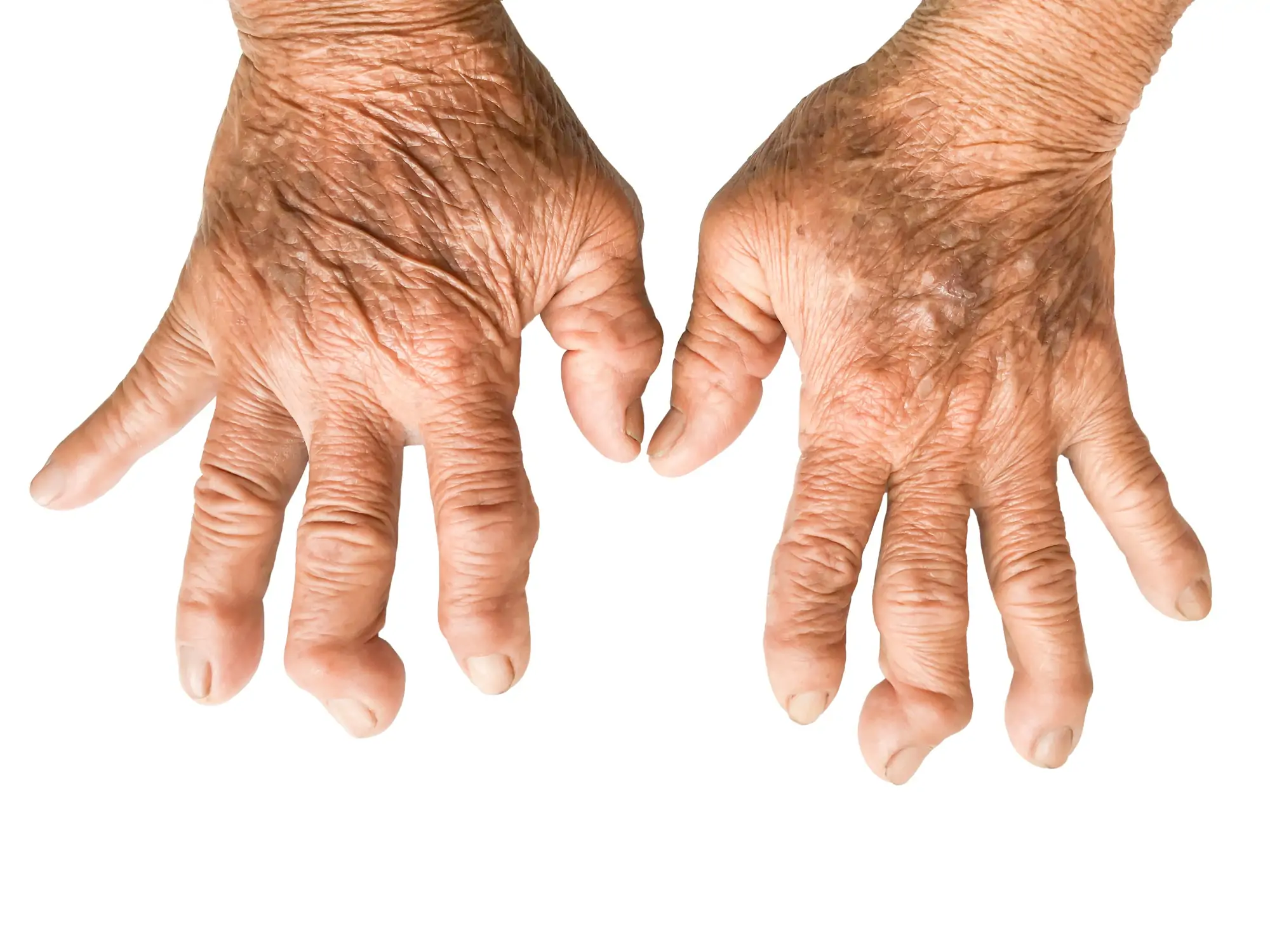 rheumatoid arthritis