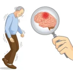 Parkinsons disease