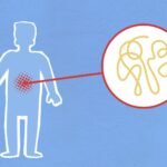 Ilustrasi usus dengan permeabilitas meningkat menunjukkan gejala leaky gut pada tubuh.