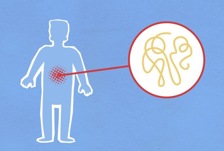 Ilustrasi usus dengan permeabilitas meningkat menunjukkan gejala leaky gut pada tubuh.
